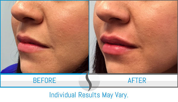 Before & After - Spa Blue Skin Care & Laser Center Orlando, FL Before & After - Spa Blue Skin Care & Laser Center Orlando, FL