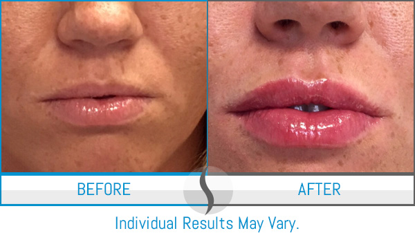 Before & After - Spa Blue Skin Care & Laser Center Orlando, FL Before & After - Spa Blue Skin Care & Laser Center Orlando, FL