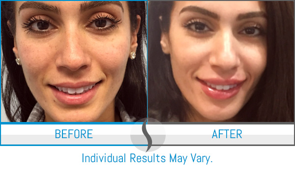 Before & After - Spa Blue Skin Care & Laser Center Orlando, FL Before & After - Spa Blue Skin Care & Laser Center Orlando, FL