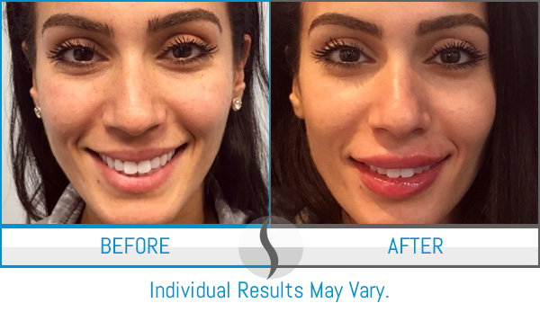 Before & After - Spa Blue Skin Care & Laser Center Orlando, FL Before & After - Spa Blue Skin Care & Laser Center Orlando, FL