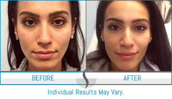 Before & After - Spa Blue Skin Care & Laser Center Orlando, FL Before & After - Spa Blue Skin Care & Laser Center Orlando, FL