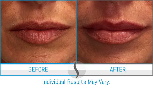 Before & After - Spa Blue Skin Care & Laser Center Orlando, FL Before & After - Spa Blue Skin Care & Laser Center Orlando, FL