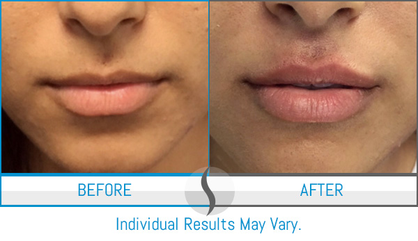 Before & After - Spa Blue Skin Care & Laser Center Orlando, FL Before & After - Spa Blue Skin Care & Laser Center Orlando, FL