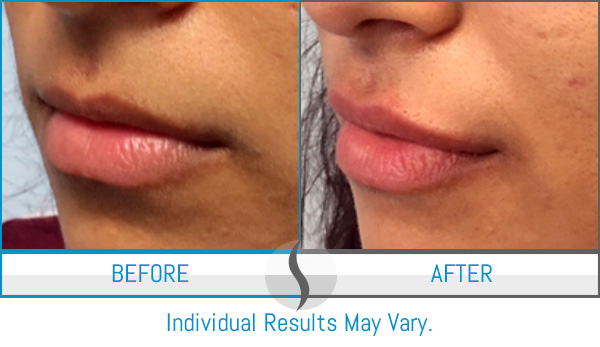 Before & After - Spa Blue Skin Care & Laser Center Orlando, FL Before & After - Spa Blue Skin Care & Laser Center Orlando, FL