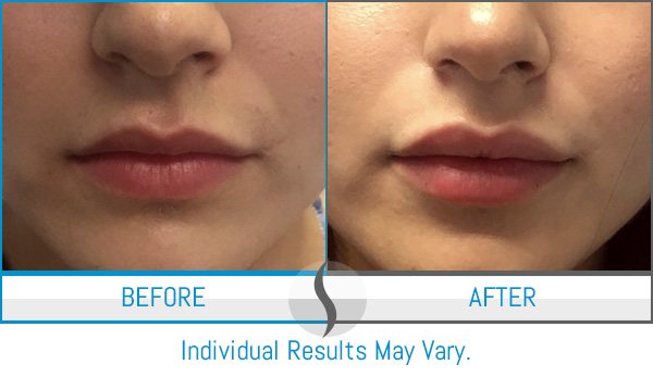 Before & After - Spa Blue Skin Care & Laser Center Orlando, FL Before & After - Spa Blue Skin Care & Laser Center Orlando, FL