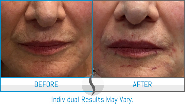 Before & After - Spa Blue Skin Care & Laser Center Orlando, FL Before & After - Spa Blue Skin Care & Laser Center Orlando, FL