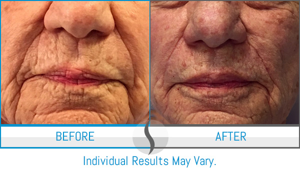 Before & After - Spa Blue Skin Care & Laser Center Orlando, FL Before & After - Spa Blue Skin Care & Laser Center Orlando, FL