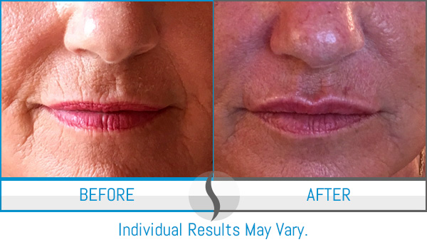 Before & After - Spa Blue Skin Care & Laser Center Orlando, FL Before & After - Spa Blue Skin Care & Laser Center Orlando, FL