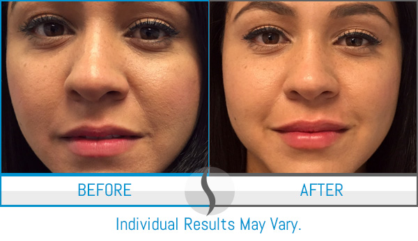 Before & After - Spa Blue Skin Care & Laser Center Orlando, FL Before & After - Spa Blue Skin Care & Laser Center Orlando, FL