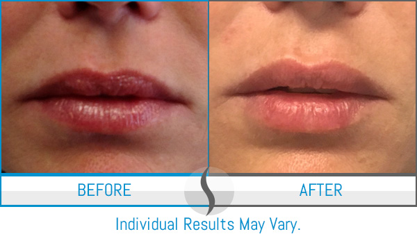 Before & After - Spa Blue Skin Care & Laser Center Orlando, FL Before & After - Spa Blue Skin Care & Laser Center Orlando, FL