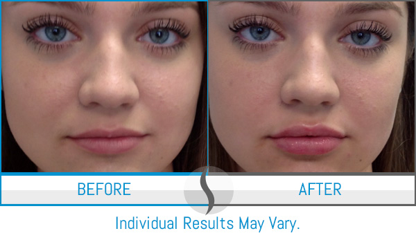 Before & After - Spa Blue Skin Care & Laser Center Orlando, FL Before & After - Spa Blue Skin Care & Laser Center Orlando, FL