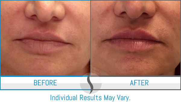 Before & After - Spa Blue Skin Care & Laser Center Orlando, FL Before & After - Spa Blue Skin Care & Laser Center Orlando, FL