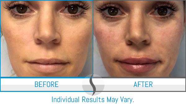 Before & After - Spa Blue Skin Care & Laser Center Orlando, FL Before & After - Spa Blue Skin Care & Laser Center Orlando, FL