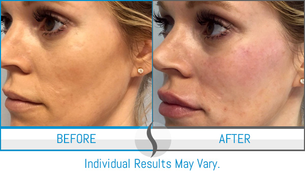 Before & After - Spa Blue Skin Care & Laser Center Orlando, FL Before & After - Spa Blue Skin Care & Laser Center Orlando, FL