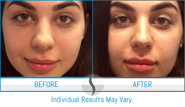 Before & After - Spa Blue Skin Care & Laser Center Orlando, FL Before & After - Spa Blue Skin Care & Laser Center Orlando, FL