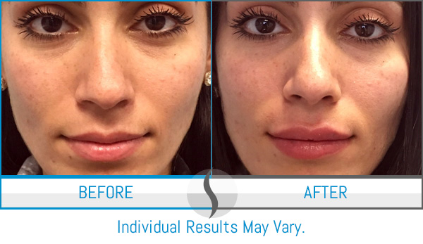 Before & After - Spa Blue Skin Care & Laser Center Orlando, FL Before & After - Spa Blue Skin Care & Laser Center Orlando, FL