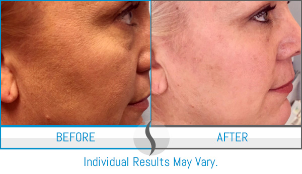 Before & After - Spa Blue Skin Care & Laser Center Orlando, FL Before & After - Spa Blue Skin Care & Laser Center Orlando, FL