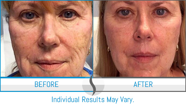 Before & After - Spa Blue Skin Care & Laser Center Orlando, FL Before & After - Spa Blue Skin Care & Laser Center Orlando, FL