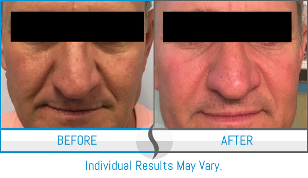 Before & After - Spa Blue Skin Care & Laser Center Orlando, FL Before & After - Spa Blue Skin Care & Laser Center Orlando, FL