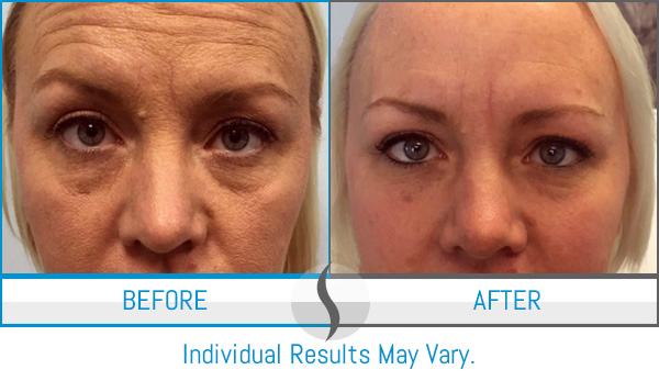 Before & After - Spa Blue Skin Care & Laser Center Orlando, FL Before & After - Spa Blue Skin Care & Laser Center Orlando, FL