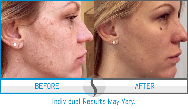 Before & After - Spa Blue Skin Care & Laser Center Orlando, FL Before & After - Spa Blue Skin Care & Laser Center Orlando, FL
