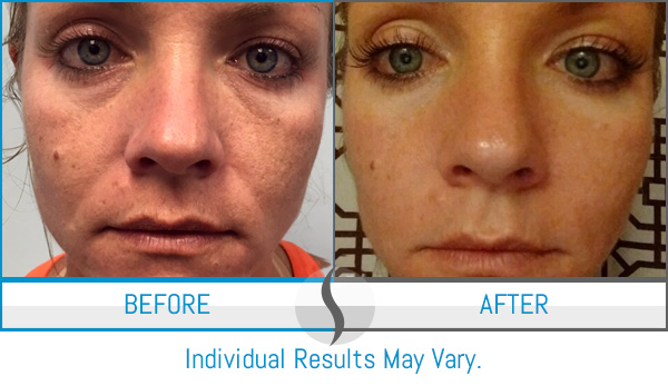 Before & After - Spa Blue Skin Care & Laser Center Orlando, FL Before & After - Spa Blue Skin Care & Laser Center Orlando, FL
