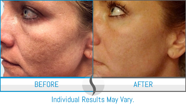 Before & After - Spa Blue Skin Care & Laser Center Orlando, FL Before & After - Spa Blue Skin Care & Laser Center Orlando, FL