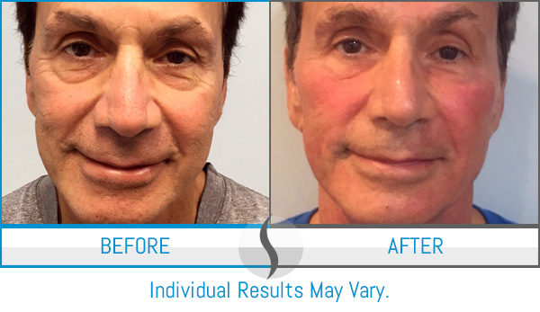 Before & After - Spa Blue Skin Care & Laser Center Orlando, FL Before & After - Spa Blue Skin Care & Laser Center Orlando, FL