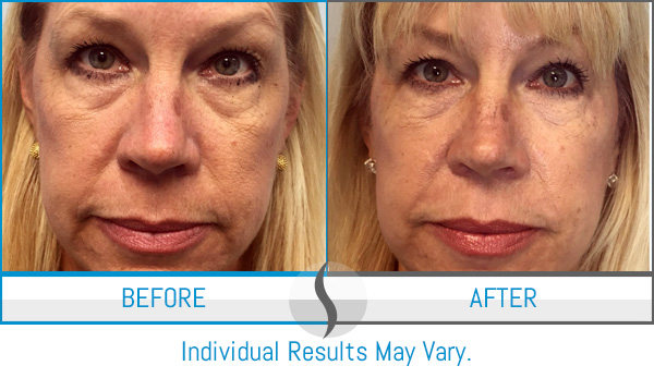 Before & After - Spa Blue Skin Care & Laser Center Orlando, FL Before & After - Spa Blue Skin Care & Laser Center Orlando, FL