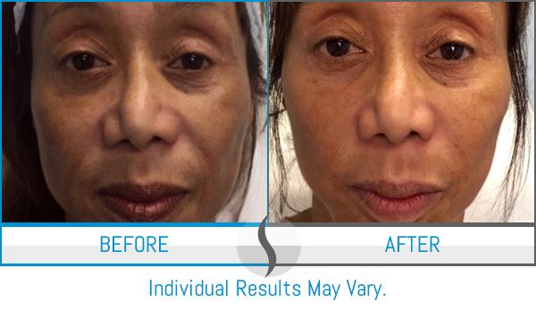 Before & After - Spa Blue Skin Care & Laser Center Orlando, FL Before & After - Spa Blue Skin Care & Laser Center Orlando, FL