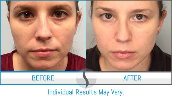 Before & After - Spa Blue Skin Care & Laser Center Orlando, FL Before & After - Spa Blue Skin Care & Laser Center Orlando, FL