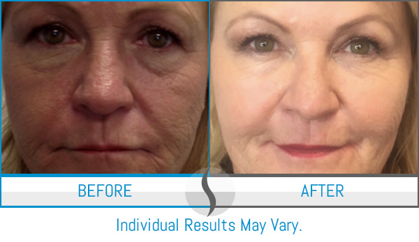 Before & After - Spa Blue Skin Care & Laser Center Orlando, FL Before & After - Spa Blue Skin Care & Laser Center Orlando, FL