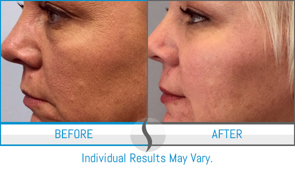 Before & After - Spa Blue Skin Care & Laser Center Orlando, FL Before & After - Spa Blue Skin Care & Laser Center Orlando, FL