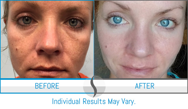 Before & After - Spa Blue Skin Care & Laser Center Orlando, FL Before & After - Spa Blue Skin Care & Laser Center Orlando, FL