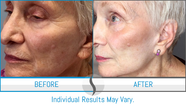 Before & After - Spa Blue Skin Care & Laser Center Orlando, FL Before & After - Spa Blue Skin Care & Laser Center Orlando, FL