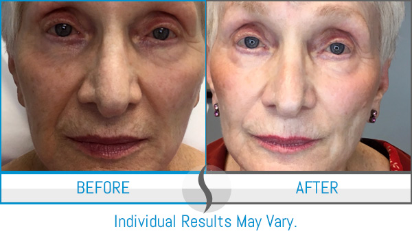 Before & After - Spa Blue Skin Care & Laser Center Orlando, FL Before & After - Spa Blue Skin Care & Laser Center Orlando, FL