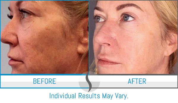 Before & After - Spa Blue Skin Care & Laser Center Orlando, FL Before & After - Spa Blue Skin Care & Laser Center Orlando, FL