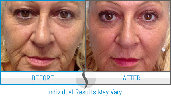 Before & After - Spa Blue Skin Care & Laser Center Orlando, FL Before & After - Spa Blue Skin Care & Laser Center Orlando, FL