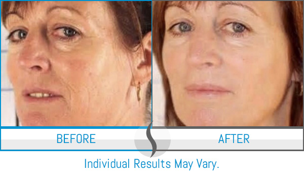 Before & After - Spa Blue Skin Care & Laser Center Orlando, FL Before & After - Spa Blue Skin Care & Laser Center Orlando, FL