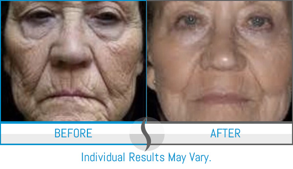 Before & After - Spa Blue Skin Care & Laser Center Orlando, FL Before & After - Spa Blue Skin Care & Laser Center Orlando, FL