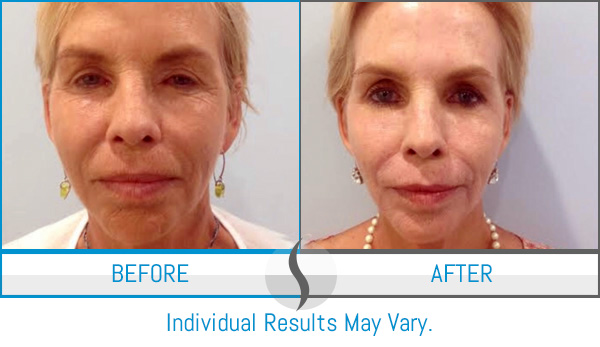 Before & After - Spa Blue Skin Care & Laser Center Orlando, FL Before & After - Spa Blue Skin Care & Laser Center Orlando, FL
