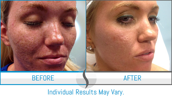 Before & After - Spa Blue Skin Care & Laser Center Orlando, FL Before & After - Spa Blue Skin Care & Laser Center Orlando, FL