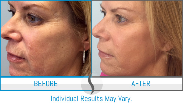 Before & After - Spa Blue Skin Care & Laser Center Orlando, FL Before & After - Spa Blue Skin Care & Laser Center Orlando, FL