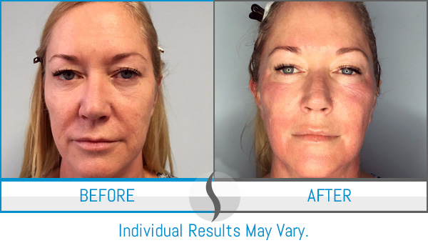 Before & After - Spa Blue Skin Care & Laser Center Orlando, FL Before & After - Spa Blue Skin Care & Laser Center Orlando, FL