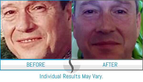 Before & After - Spa Blue Skin Care & Laser Center Orlando, FL Before & After - Spa Blue Skin Care & Laser Center Orlando, FL