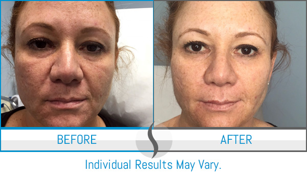 Before & After - Spa Blue Skin Care & Laser Center Orlando, FL Before & After - Spa Blue Skin Care & Laser Center Orlando, FL