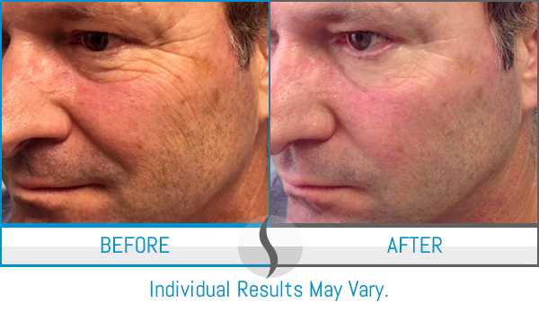 Before & After - Spa Blue Skin Care & Laser Center Orlando, FL Before & After - Spa Blue Skin Care & Laser Center Orlando, FL