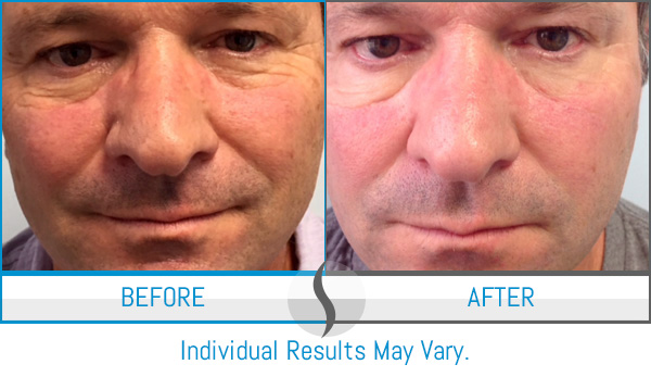 Before & After - Spa Blue Skin Care & Laser Center Orlando, FL Before & After - Spa Blue Skin Care & Laser Center Orlando, FL