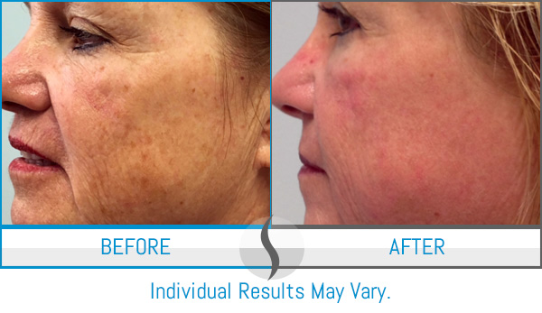 Before & After - Spa Blue Skin Care & Laser Center Orlando, FL Before & After - Spa Blue Skin Care & Laser Center Orlando, FL