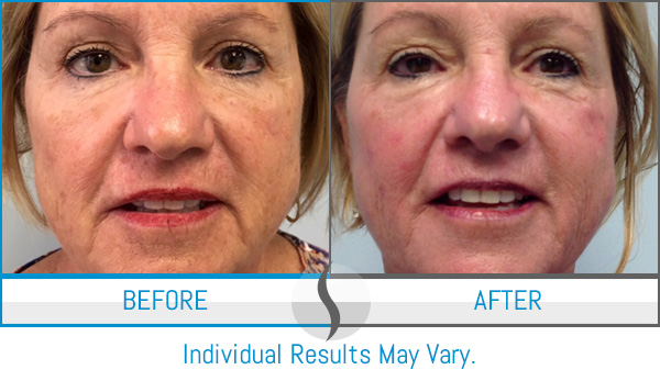Before & After - Spa Blue Skin Care & Laser Center Orlando, FL Before & After - Spa Blue Skin Care & Laser Center Orlando, FL